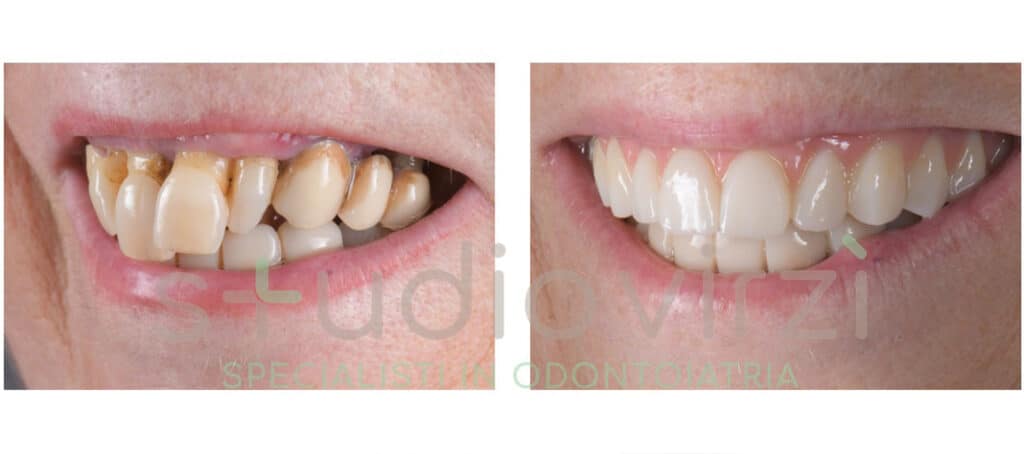 Implantologia a carico immediato