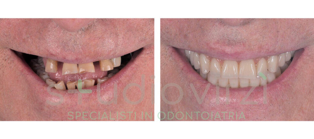 Denti che si muovono