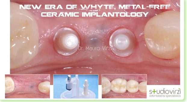 impianti in zirconia