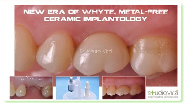 impianti in zirconia