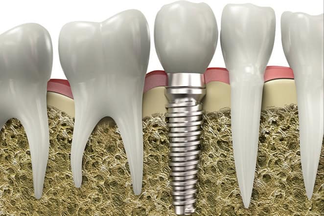 Quanto costa un impianto dentale nel 2026