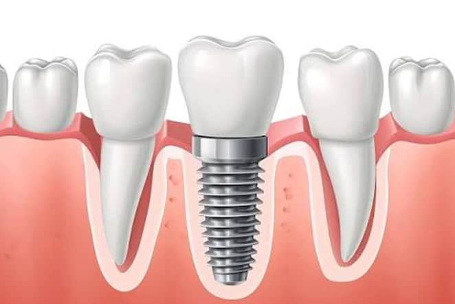 Quanto costa un impianto dentale nel 2026